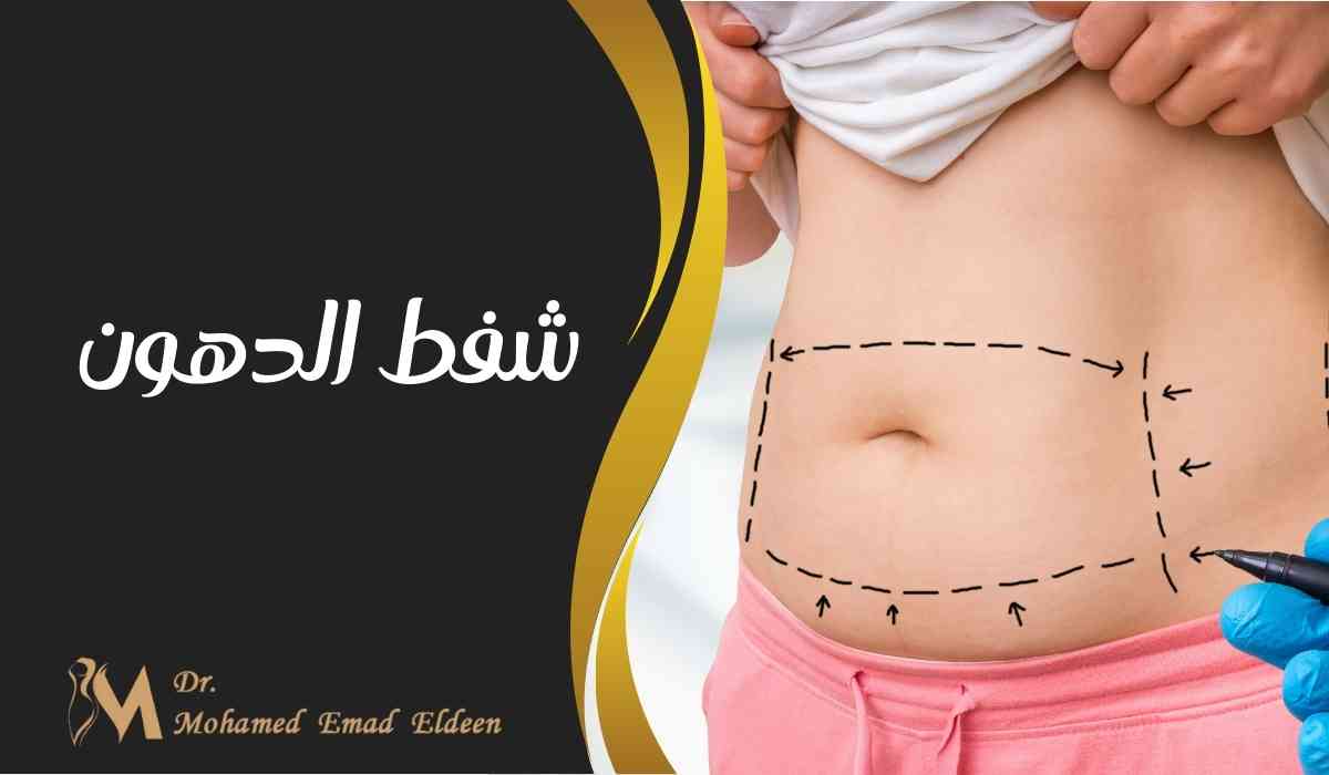 شفط الدهون